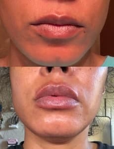 Customer photo review of Plumping Lip filler