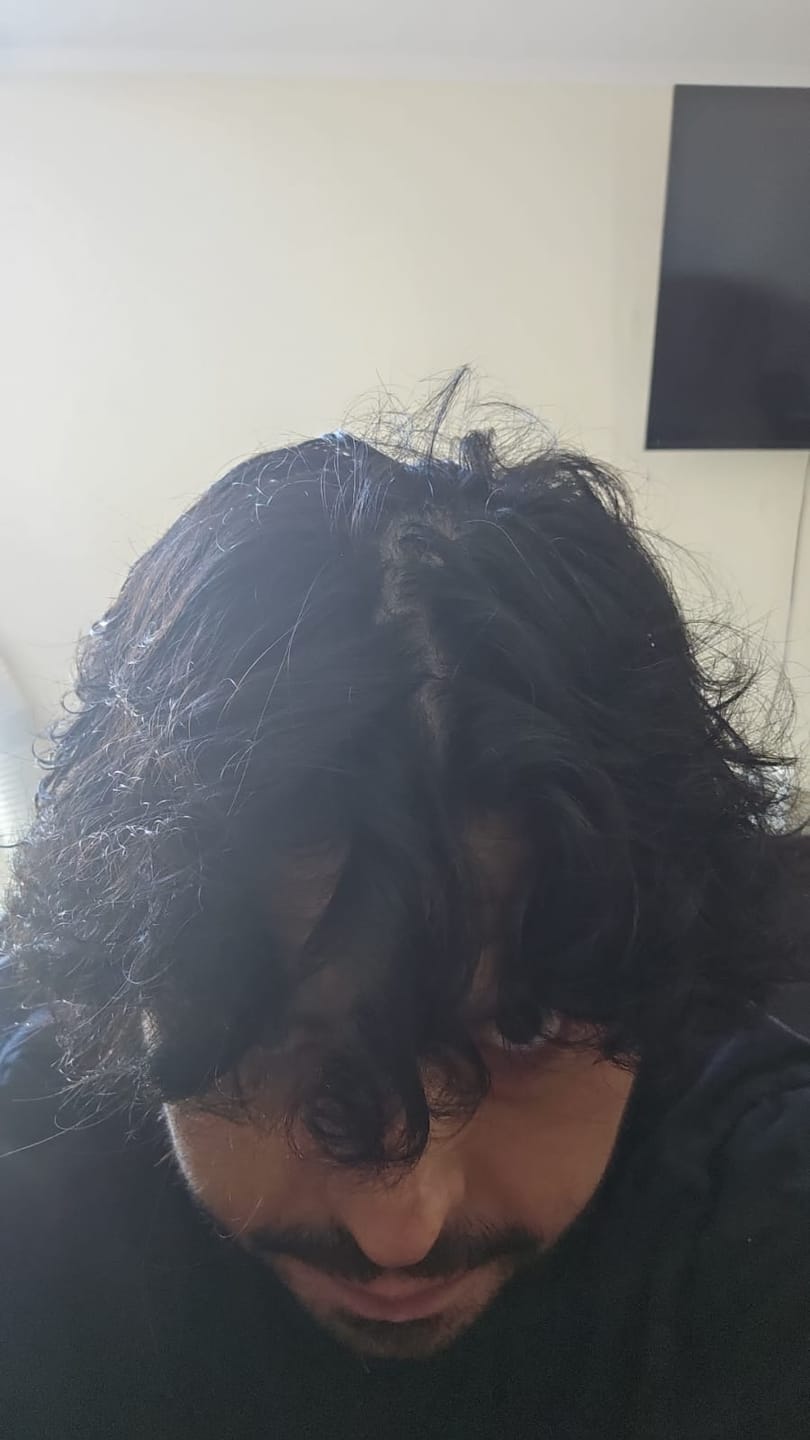 Customer photo review of Pack Anticaída de Cabello para 1 Mes