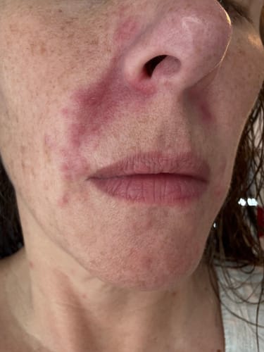 Close-up of a reviewer's face with red, inflamed skin around the nose and mouth before using F-Balm for perioral dermatitis.