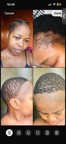 Customer photo review of Minoxidil REGULAR (2%) strength SOLUTION, 3x60ml pack