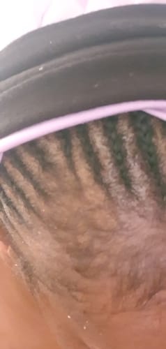 Customer photo review of Minoxidil High Strength (5%) SOLUTION, 3x60ml pack