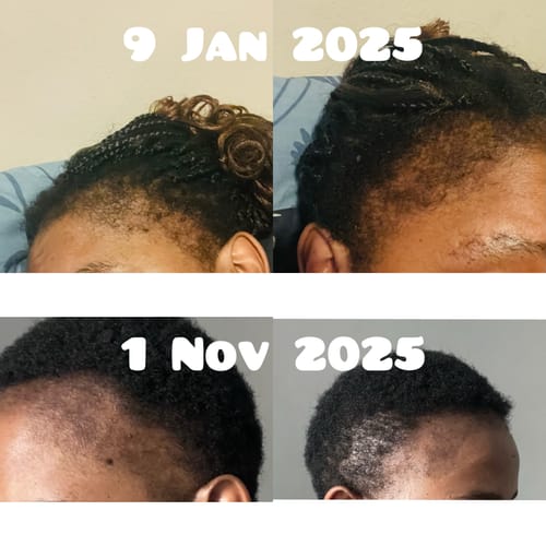Customer photo review of Minoxidil High Strength (5%) SOLUTION, 3x60ml pack