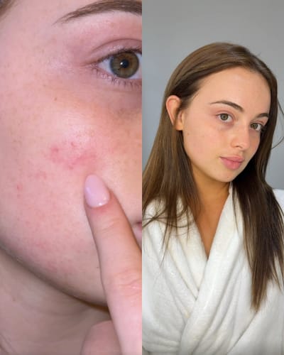 Customer photo review of Redness Relief Bundle