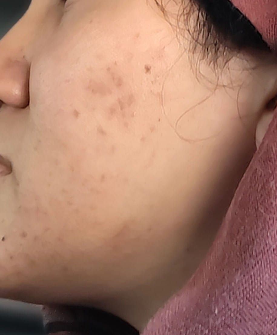 Customer photo review of NiaRonic Serum (Pore Minimizing)