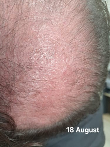 Customer photo review of Minoxidil DOUBLE ACTION FOAM, MEN ONLY 3x60ml Pack
