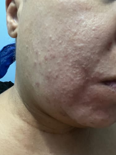 Customer photo review of Deep Cleansing & Pore Care Set