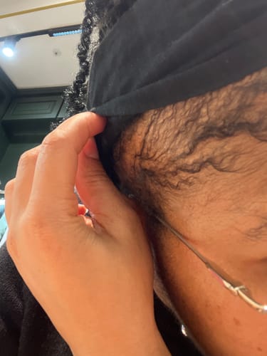 Customer photo review of Minoxidil High Strength (5%) FOAM, 3x60ml pack