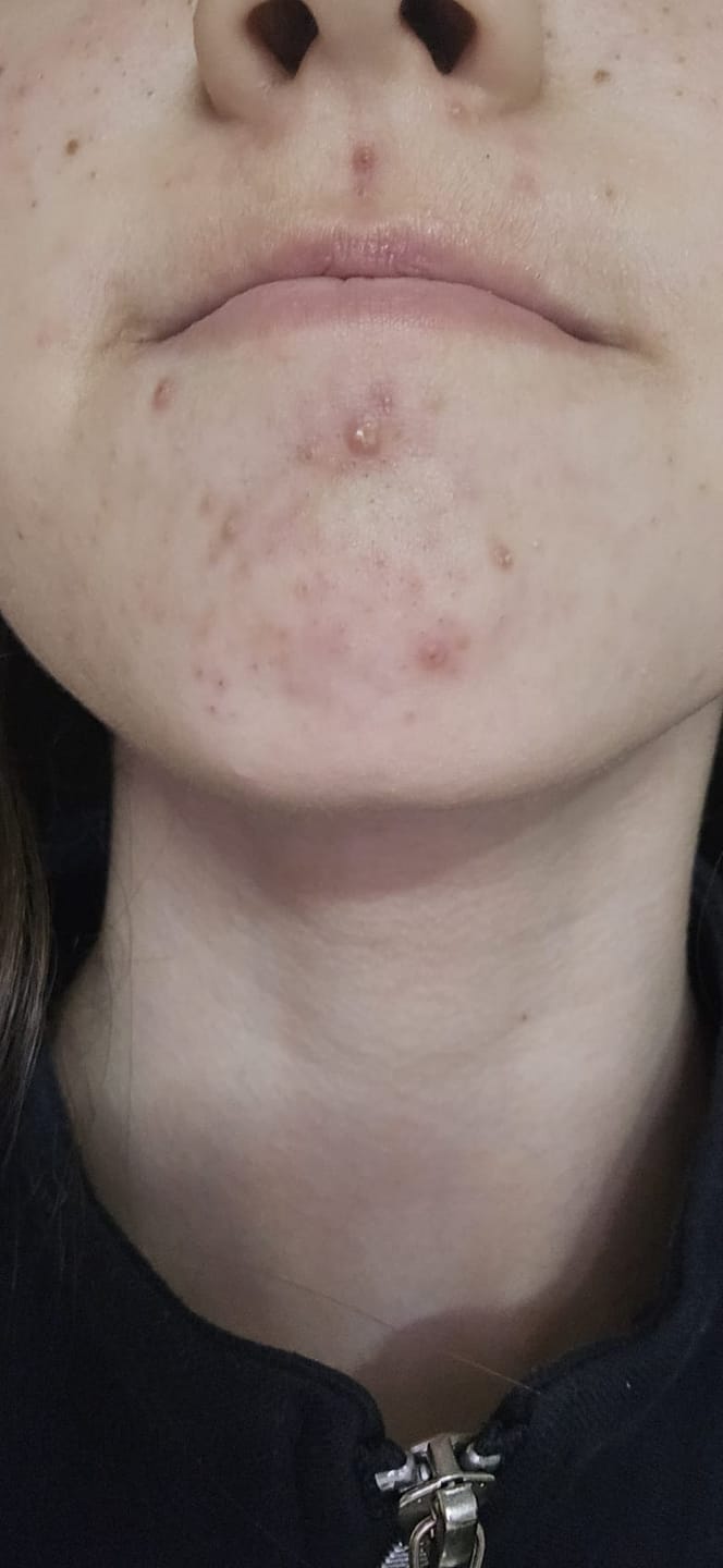 Customer photo review of Acne Care Phage Gel – gel pentru tenul cu tendință acneică
