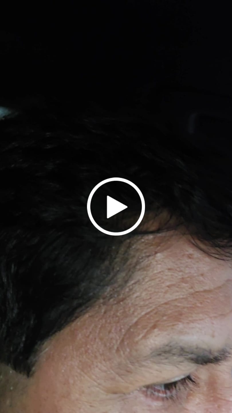 Customer video review of Minoxidil 5 mg con 90 tabletas para 3 meses de tratamiento