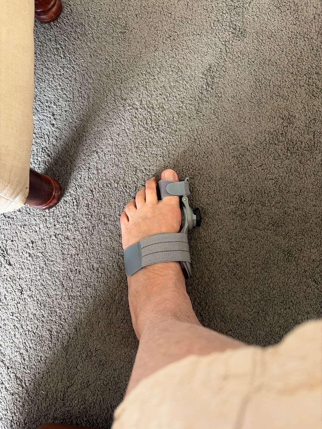 Customer photo review of Treatmedy™ Bunion Fix
