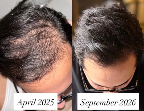 Reviewer's hair comparison showing increased density and fullness from April 2025 to September 2026.