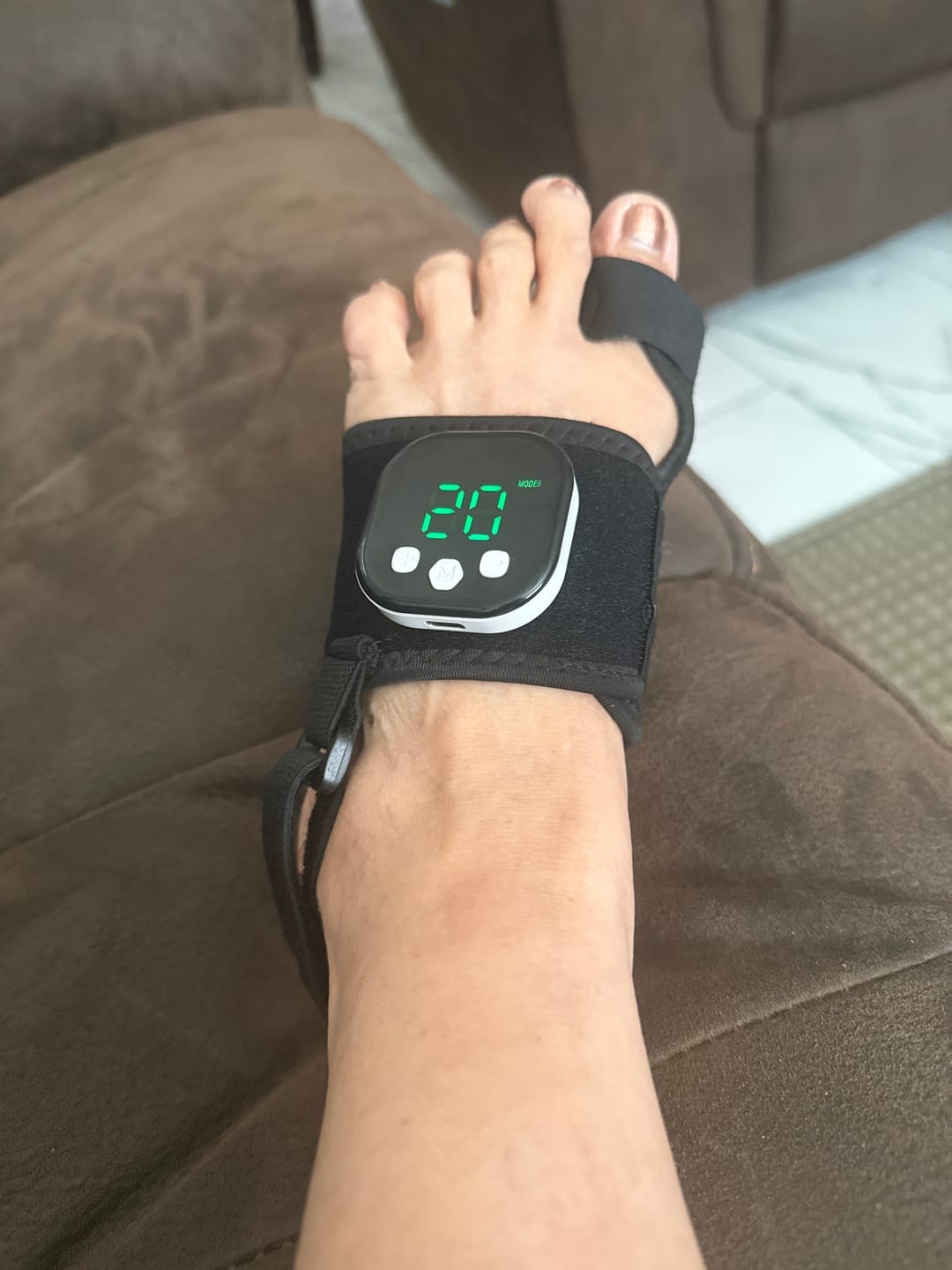 Customer photo review of ToeShape-EMS Bunion Corrector