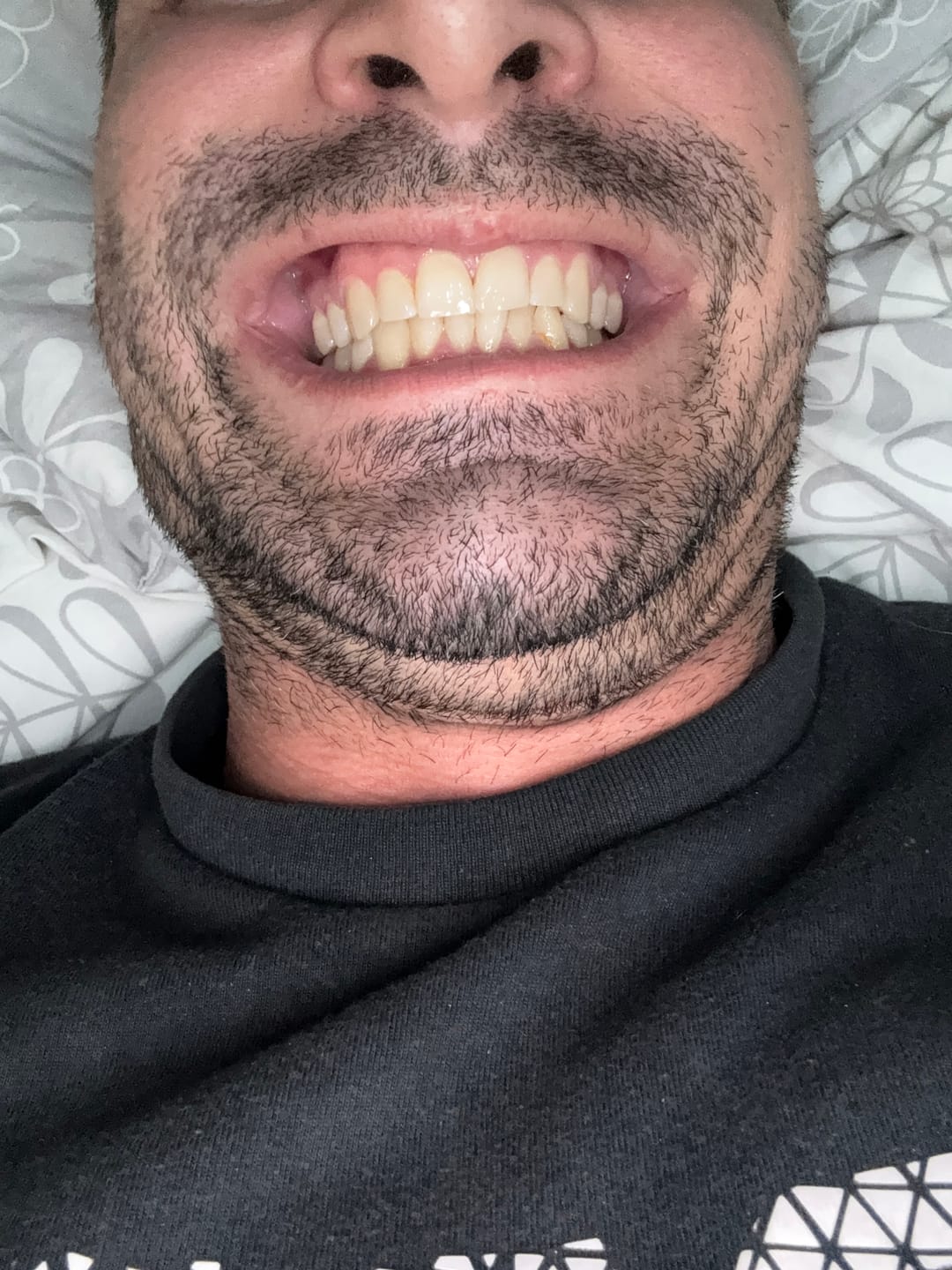 Customer photo review of V34 bieliace pásiky na zuby (14 aplikácií)