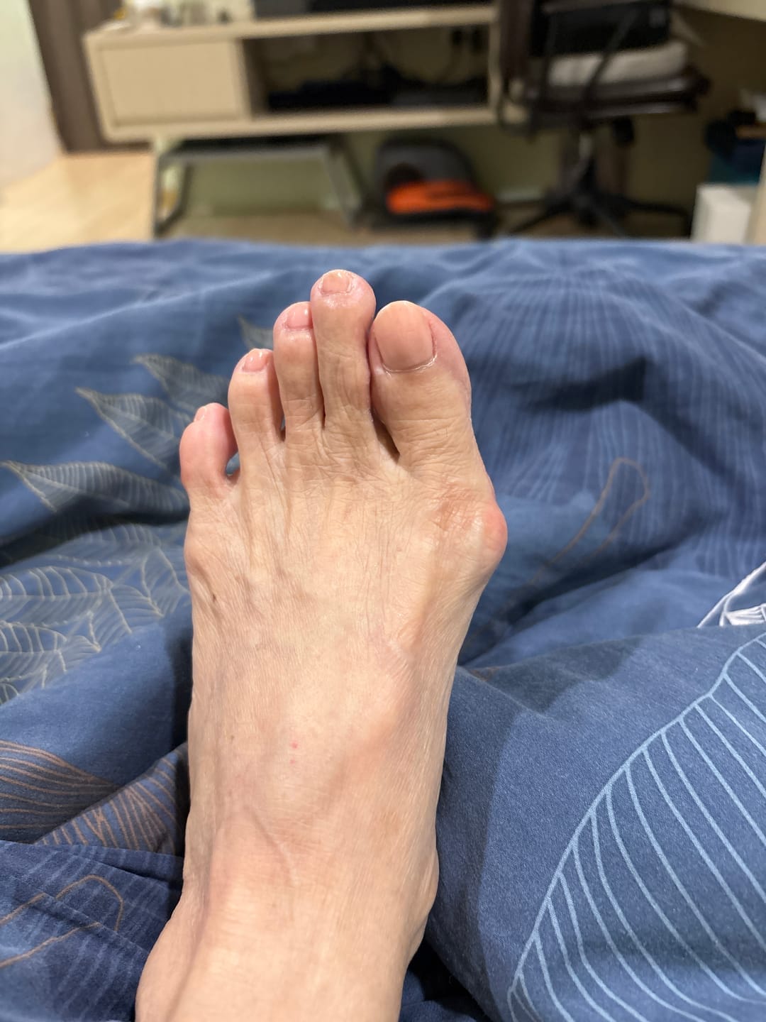 Customer photo review of ToeShape-EMS Bunion Corrector
