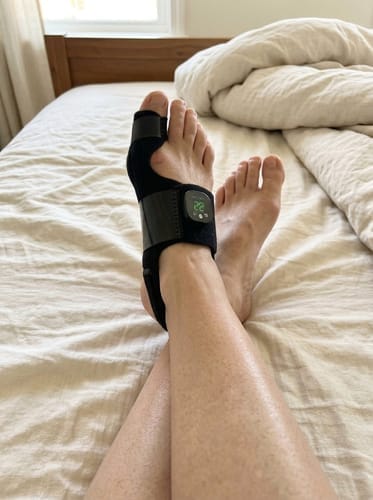 Customer photo review of ToeShape-EMS Bunion Corrector