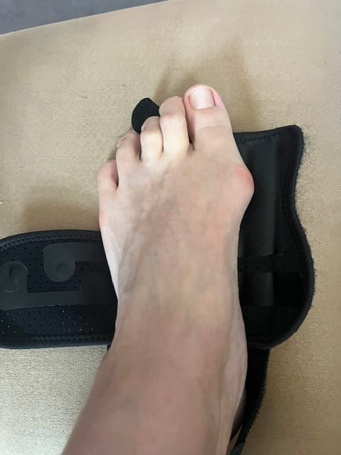 Customer photo review of ToeShape-EMS Bunion Corrector