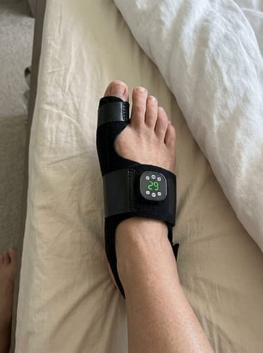 Customer photo review of ToeShape-EMS Bunion Corrector