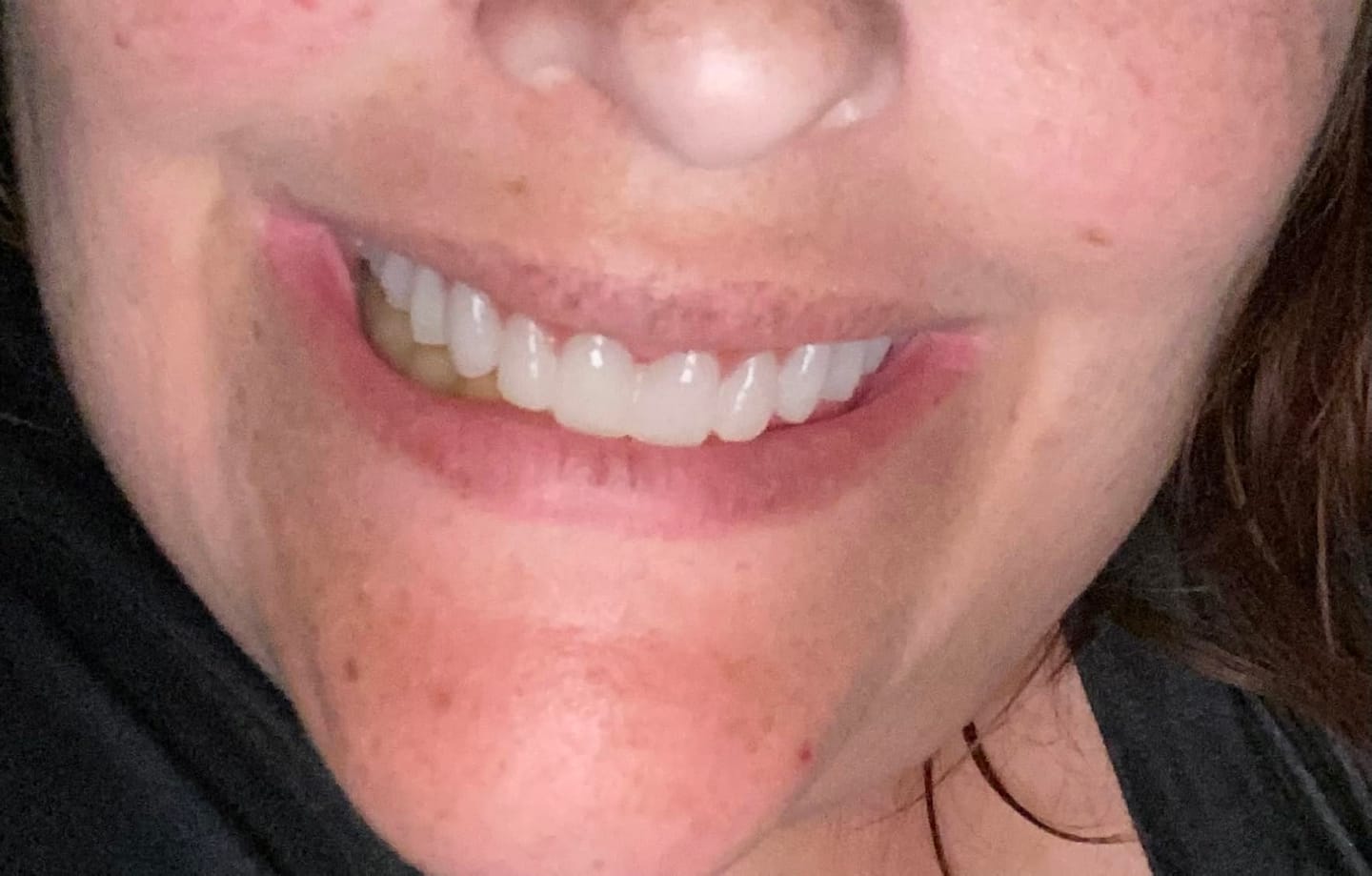 Customer photo review of Boil-And-Bite Medical-Grade Denture Set (Upper & Lower)