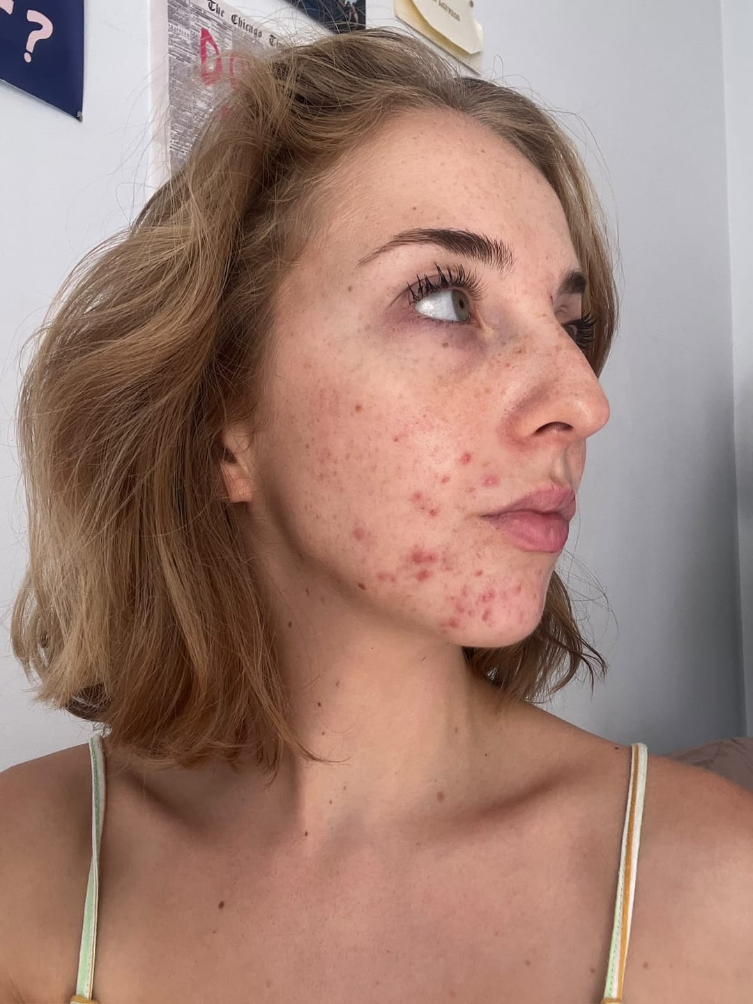 Customer photo review of A CONTROL - ACNÉ HORMONAL & RESISTENCIA A LA INSULINA