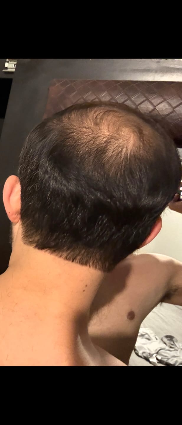 Customer photo review of SKALPURE Cubre Alopecia y Coronilla al Instante