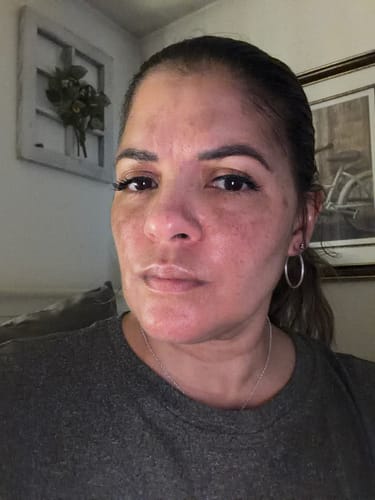 Customer's face showing gradual skin tone improvement after using The Micro Infusion System™ for two months.