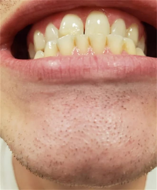 Customer photo review of DailyGlowSmile® Triple Action Teeth Whitening Powder