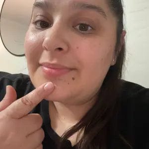 Customer photo review of Zero-Fit Korean Pimple Patch Duo