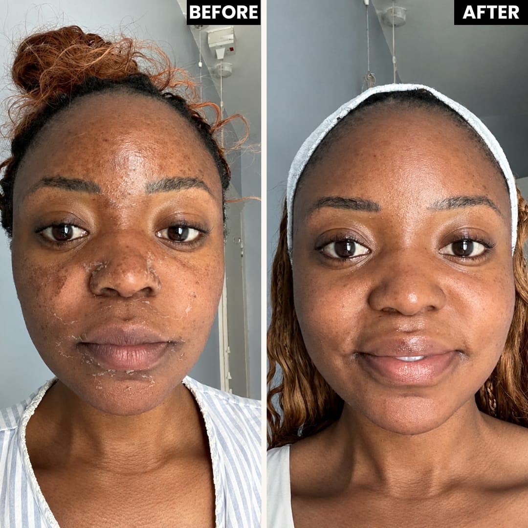 Customer photo review of Peel Shot Kojic Acid Turmeric Spray