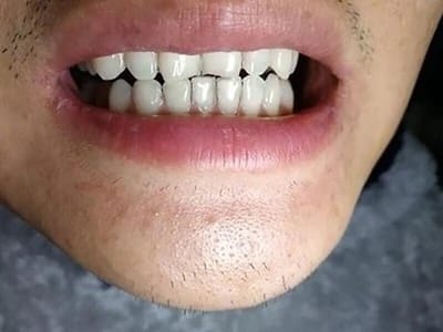 Customer photo review of DailyGlowSmile® Triple Action Teeth Whitening Powder