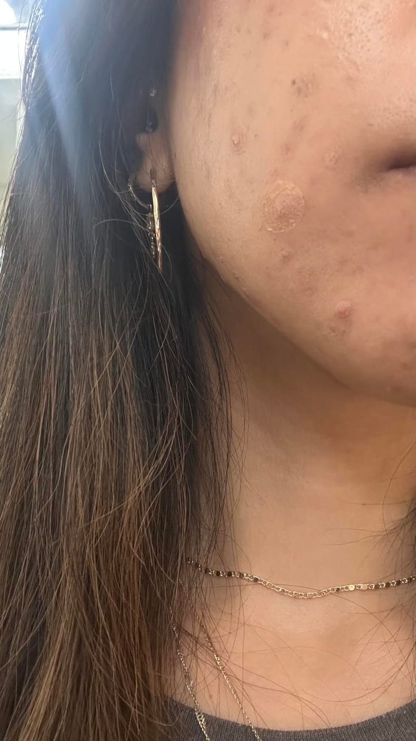 Customer photo review of Zero-Fit Korean Pimple Patch Duo