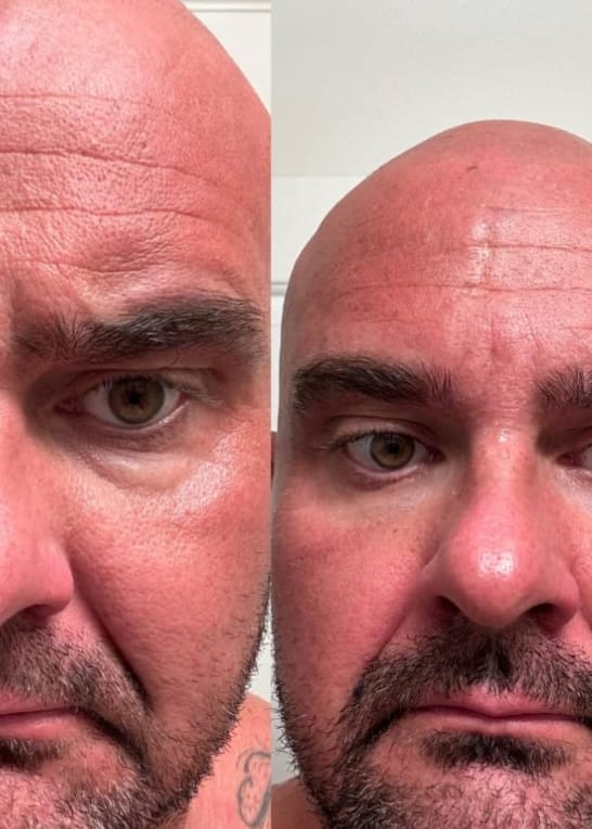 Customer photo review of ProLift 2.0 Micro-Conos para Ojos Maduros Hombres