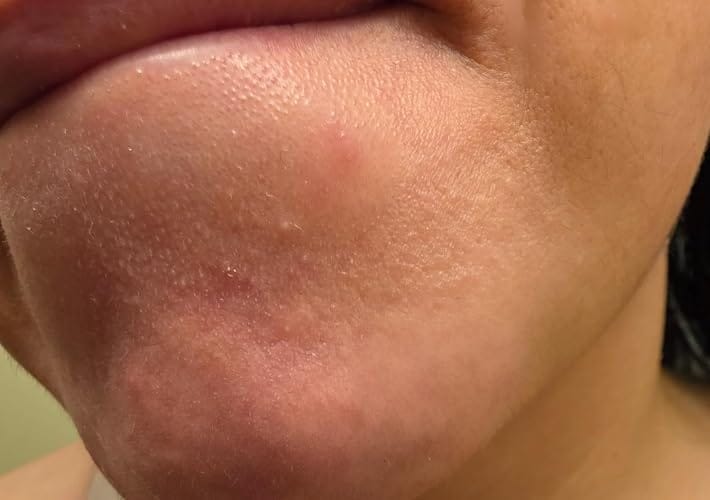 Customer photo review of Zero-Fit Korean Pimple Patch Duo