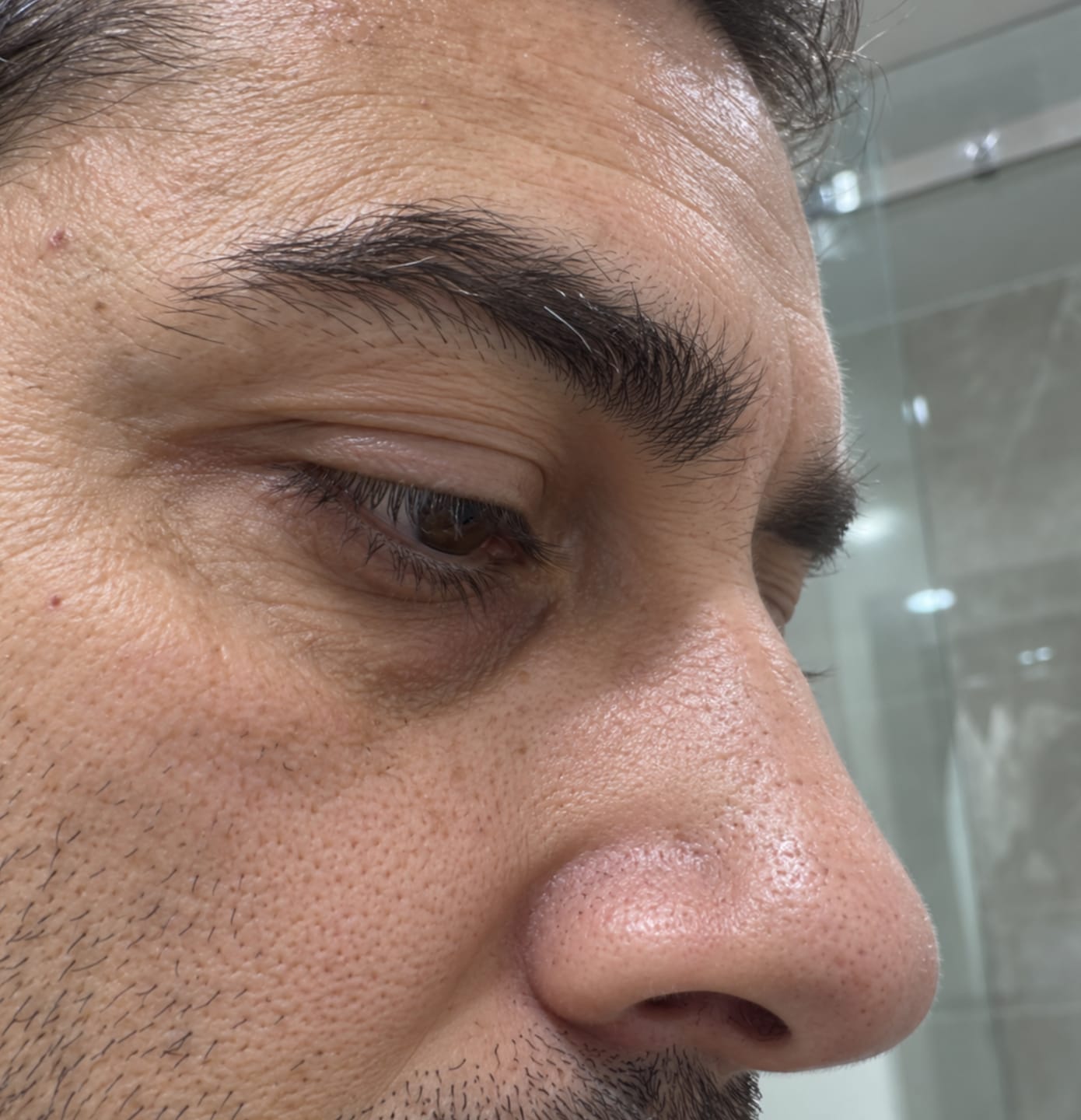Customer photo review of ProLift 2.0 Micro-Conos para Ojos Maduros Hombres