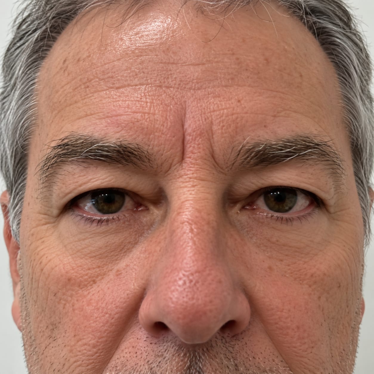 Customer photo review of ProLift 2.0 Micro-Conos para Ojos Maduros Hombres