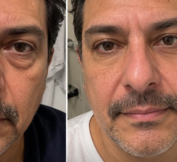 Customer photo review of ProLift 2.0 Micro-Conos para Ojos Maduros Hombres