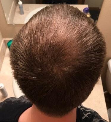 Customer photo review of Vanalie™ Hair Growth Roll-On Serum