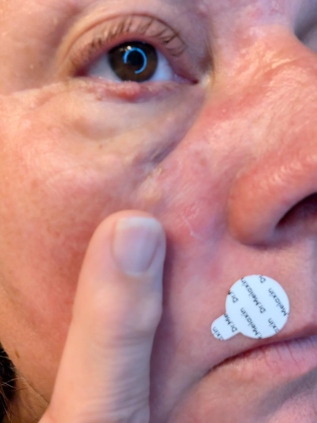 Customer photo review of Zero-Fit Korean Pimple Patch Duo