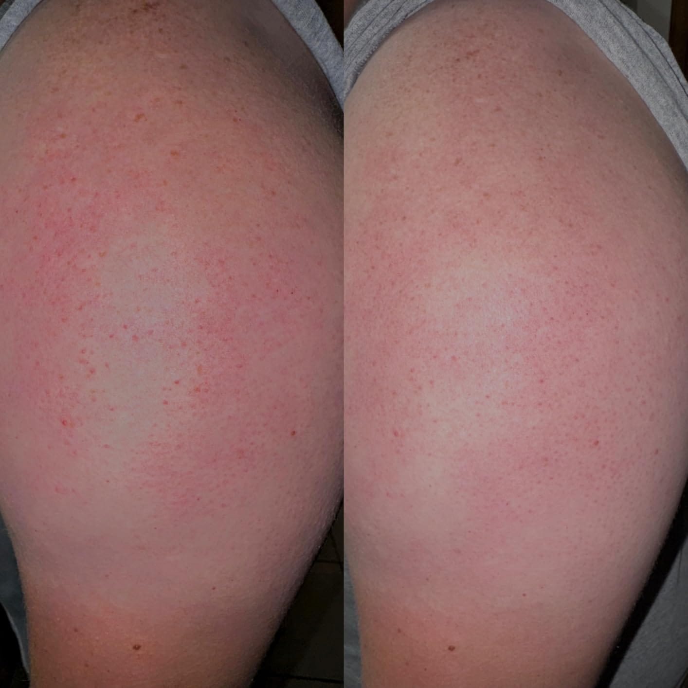 Customer photo review of Peel Shot Kojic Acid Turmeric Spray