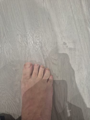 Customer's foot after 6 weeks of using Fungal Freedom conditioning oil