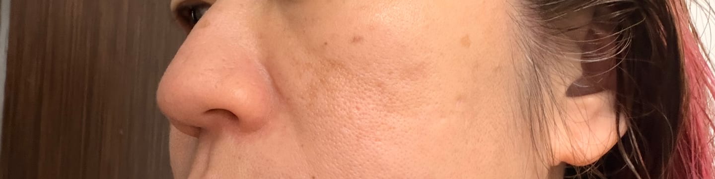 Customer photo review of Ventamin Light Up: Doctor-Formulated Brightening Formula for Melasma, Acne scars & Hyperpigmentation