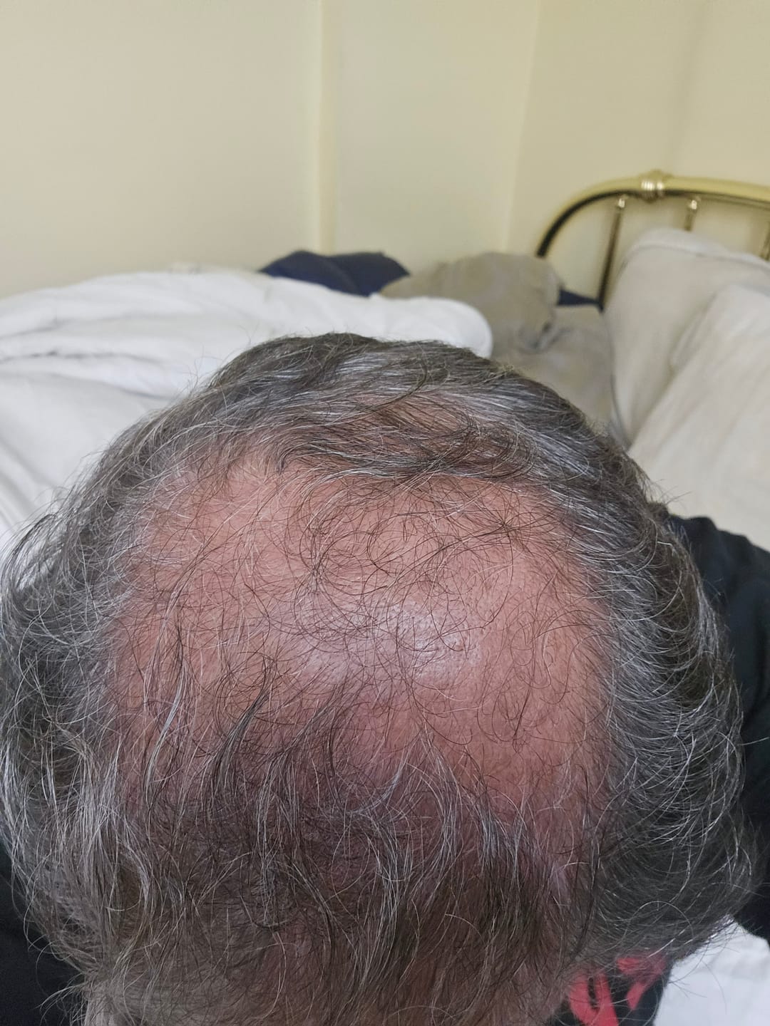 Customer photo review of SPARTAN™ - Full Hair Growth System