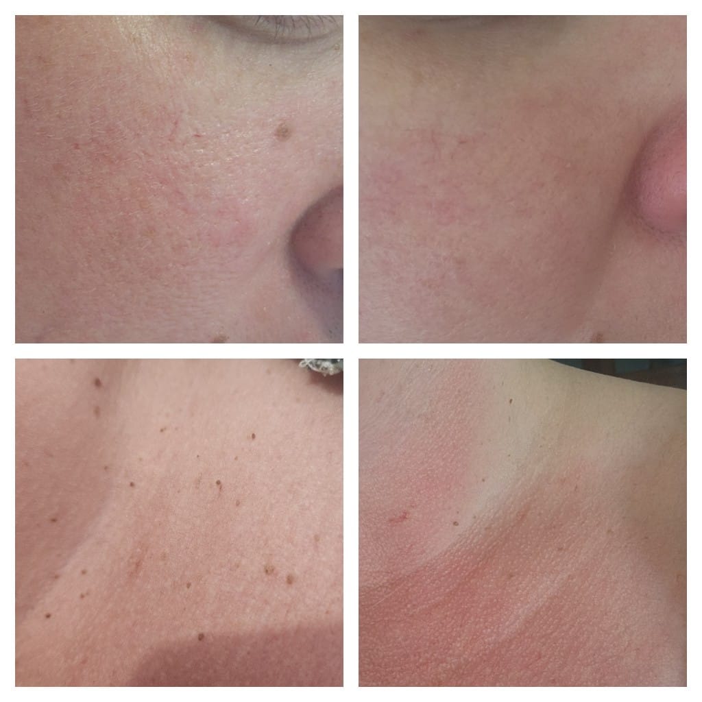Customer photo review of The Viral Magnesium Super Stick™ — For Skin Tags, Moles, Keratosis & Blemishes