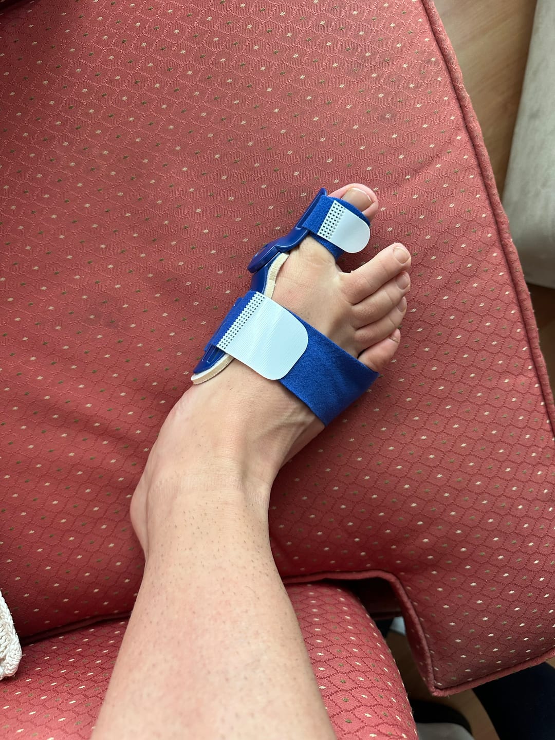 Customer photo review of MYOFILL Align