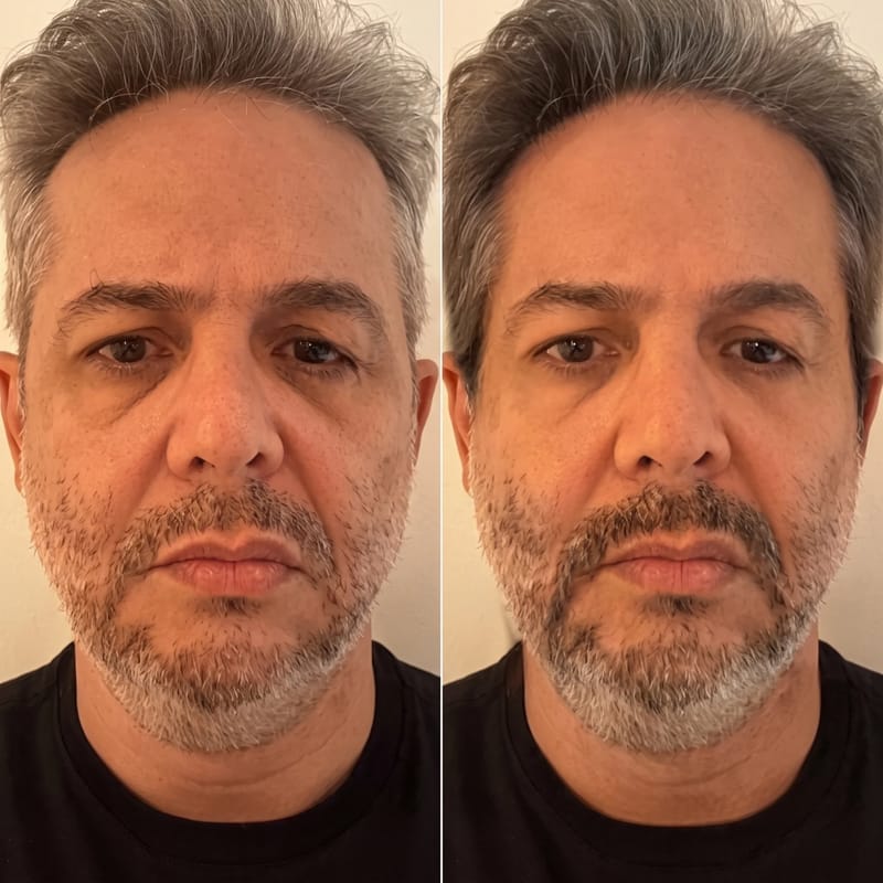 Customer photo review of Onalumi™ Mikronadel-Augenpatches