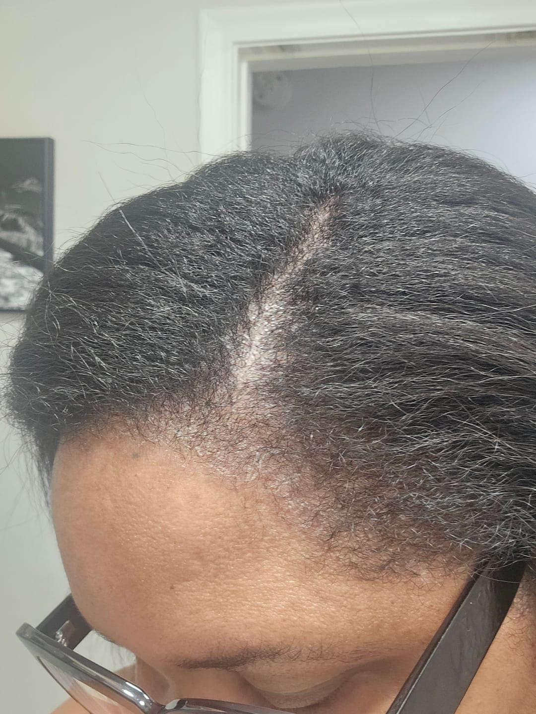 Customer photo review of Scalp Therapy System