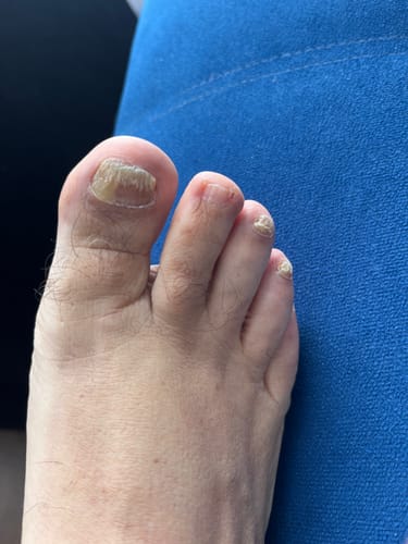 Customer photo review of MyCurePro® · Elimina hongos en pies y manos · 7 días