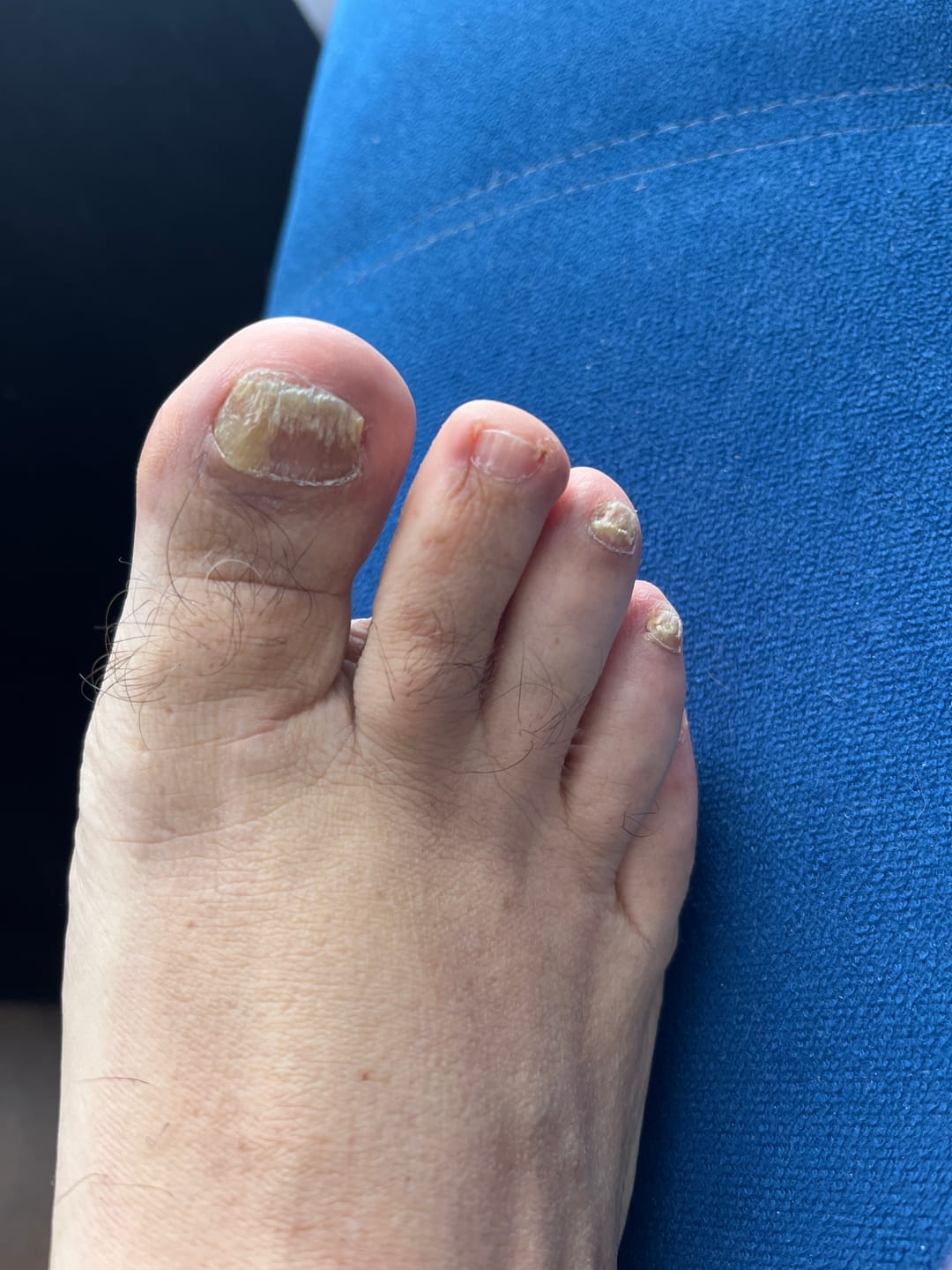 Customer photo review of MyCurePro® · Elimina hongos en pies y manos · 7 días