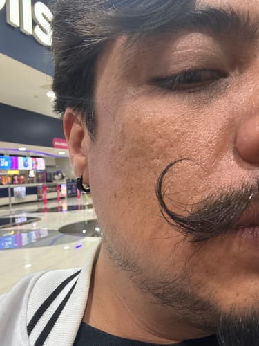 Customer photo review of Bálsamo Mélamus - Minoxidil 20%