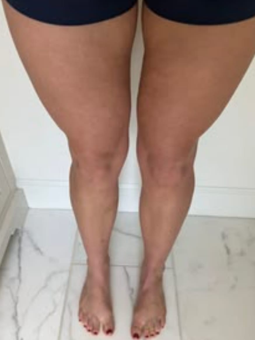 Customer photo review of Haarentfernungsschaum