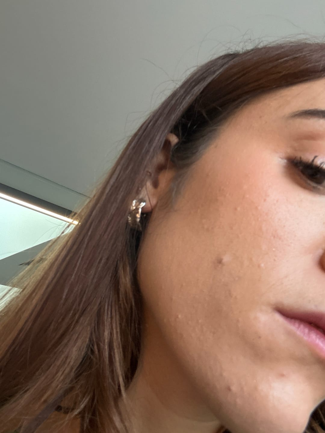 Customer photo review of Balm for Acne-Prone Skin
